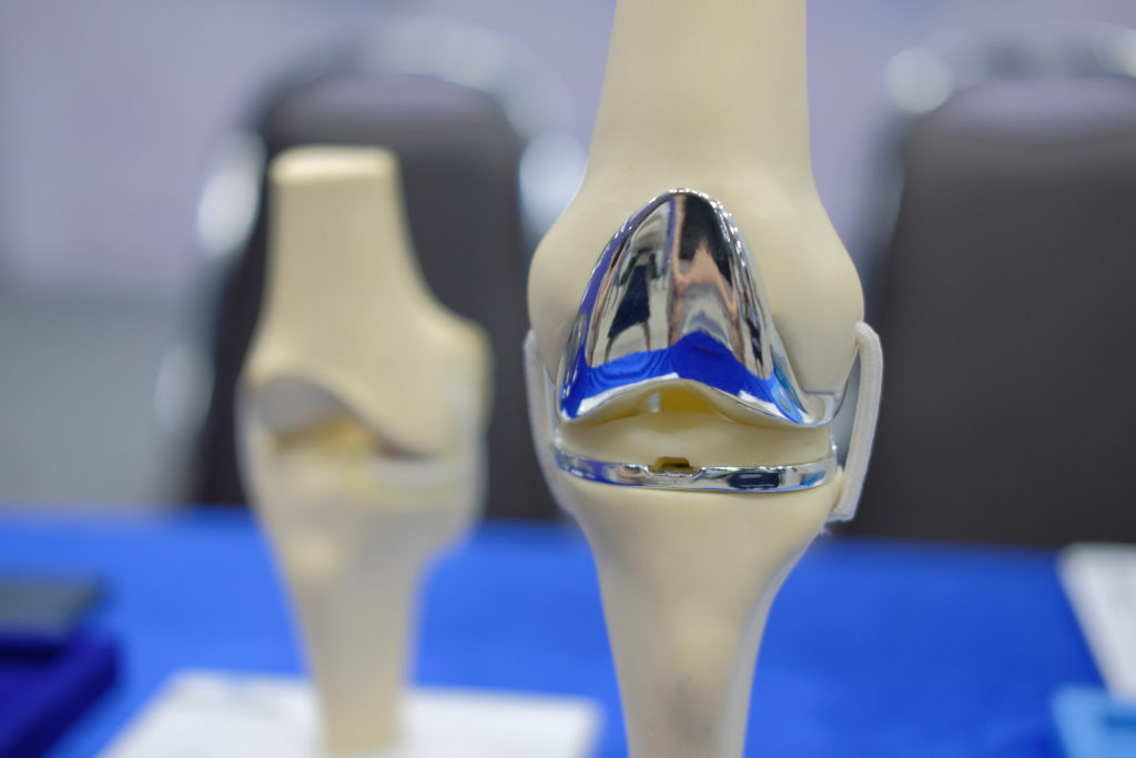 Knee Joint Model After Replacement Surgery Orthorehab Edina Physical Therapists